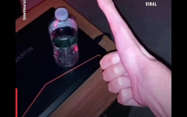 A College Kid with an Insane Five-Inch Thumb Is Going Viral